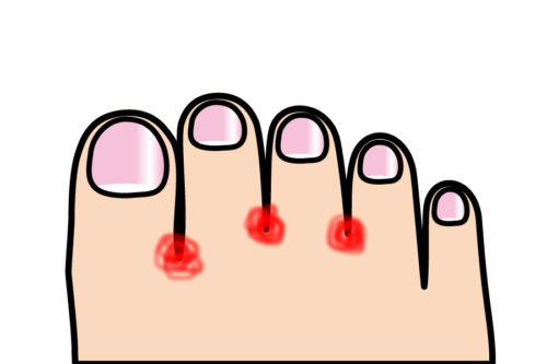 足の指3